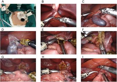 Comparative study of robotic-assisted single-incision-plus-one port and single-incision laparoscopic choledochal cyst excision